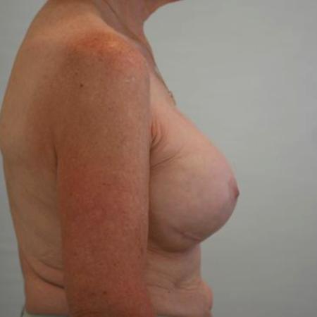 After image 3 Case #121931 - Breast Revision