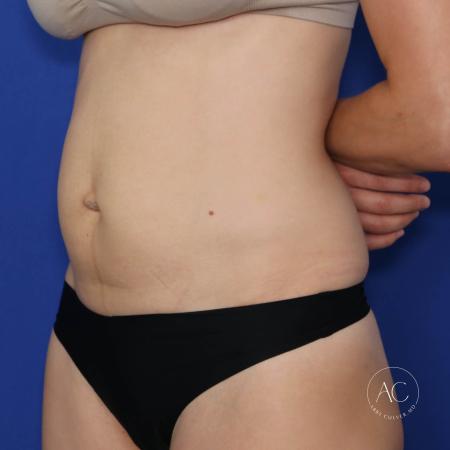 Before image 2 Case #122076 - Abdominoplasty