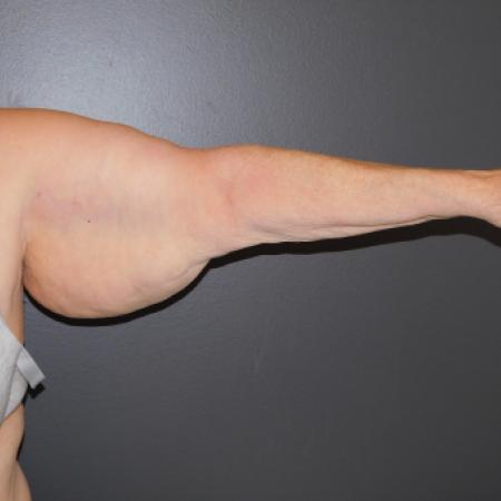 Before image 1 Case #122361 - Brachioplasty with liposuction