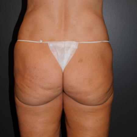 Before image 1 Case #122376 - Buttock Lift