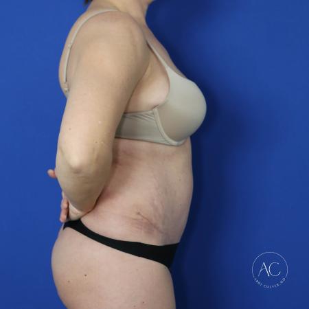 After image 3 Case #122091 - Abdominoplasty with Circumferential Liposuction