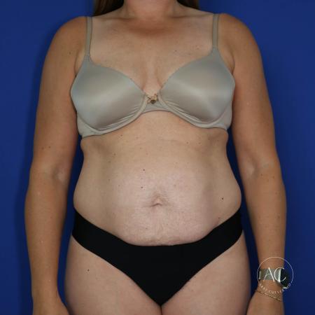 Before image 1 Case #122091 - Abdominoplasty with Circumferential Liposuction