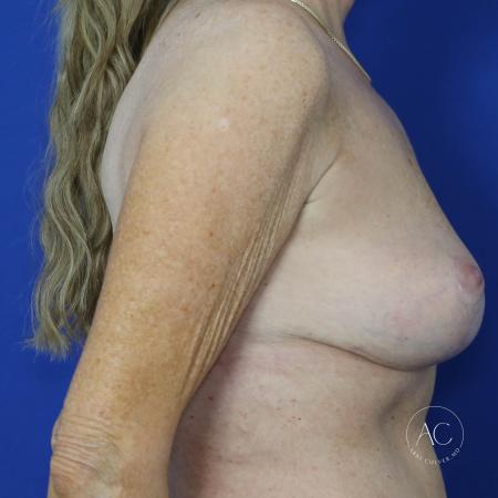 After image 3 Case #122086 - Mastopexy