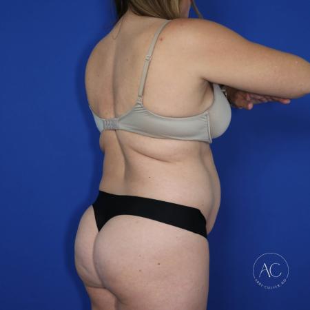 Before image 4 Case #122091 - Abdominoplasty with Circumferential Liposuction