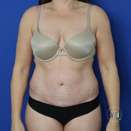 After image 1 Case #122091 - Abdominoplasty with Circumferential Liposuction