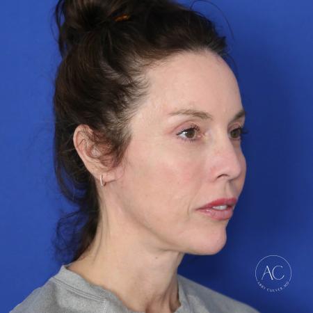 After image 2 Case #122096 - Facial Rejuvenation