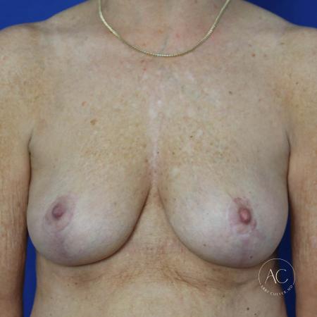 After image 1 Case #122086 - Mastopexy