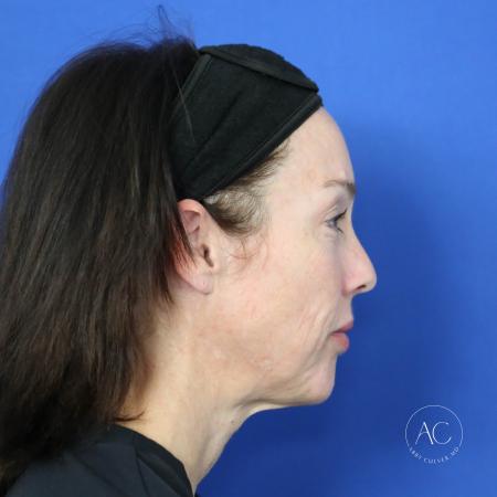 Before image 3 Case #122096 - Facial Rejuvenation