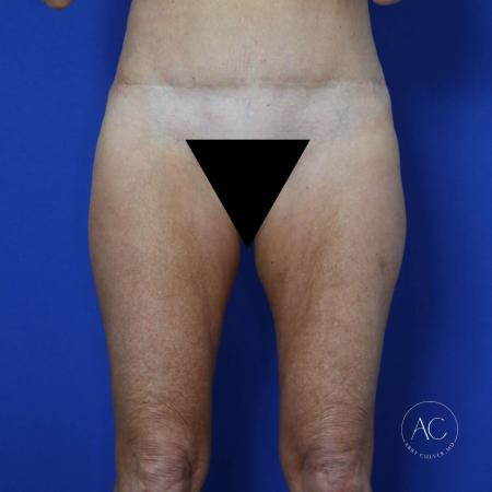 Before image 1 Case #122081 - Thighplasty with Liposuction