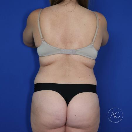 Before image 5 Case #122091 - Abdominoplasty with Circumferential Liposuction