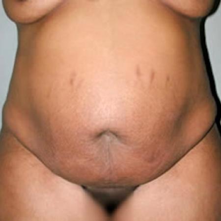 Before image 3 Case #122011 - Mommy Makeover Tummy Tuck 