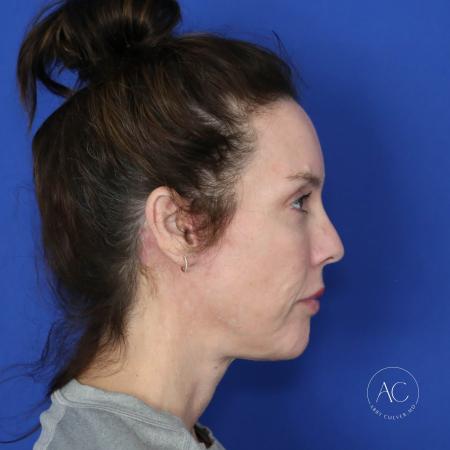 After image 3 Case #122096 - Facial Rejuvenation