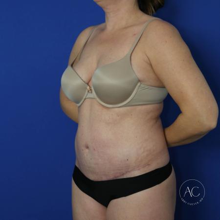 After image 2 Case #122091 - Abdominoplasty with Circumferential Liposuction