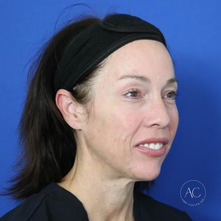 Before image 2 Case #122096 - Facial Rejuvenation