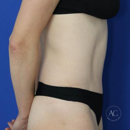 After image 3 Case #122076 - Abdominoplasty