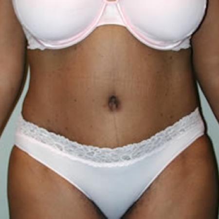 After image 3 Case #122006 - Mommy Makeover Tummy Tuck