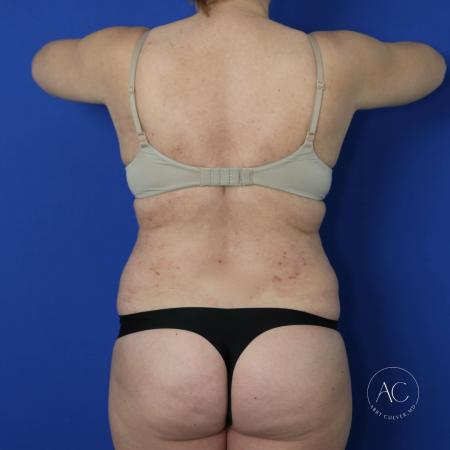 After image 5 Case #122091 - Abdominoplasty with Circumferential Liposuction