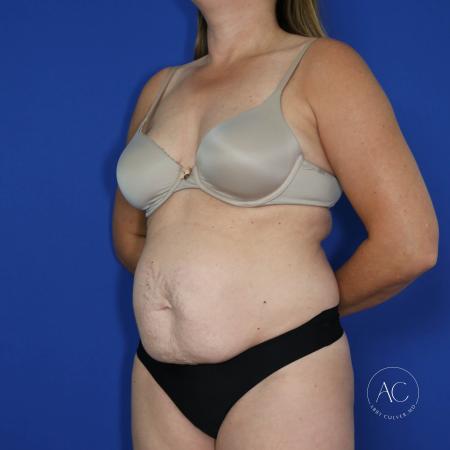 Before image 2 Case #122091 - Abdominoplasty with Circumferential Liposuction