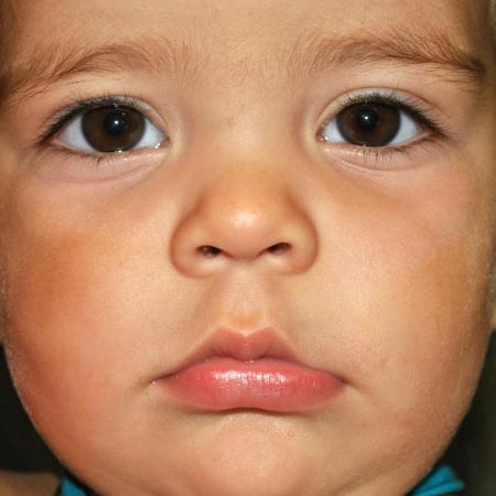 After image 1 Case #122871 - Congenital Vascular Malformation After image 1 Case #122871 - Congenital Vascular Malformation