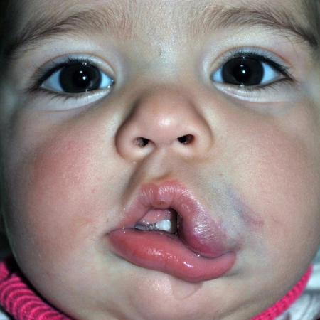 Before image 1 Case #122871 - Congenital Vascular Malformation Before image 1 Case #122871 - Congenital Vascular Malformation