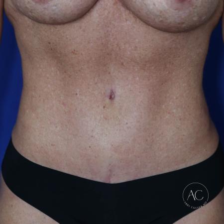 After image 1 Case #124936 - Abdominoplasty After image 1 Case #124936 - Abdominoplasty
