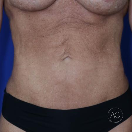 Before image 1 Case #124936 - Abdominoplasty Before image 1 Case #124936 - Abdominoplasty