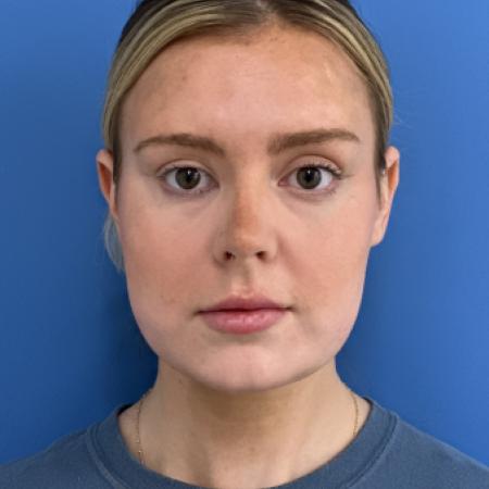 After image 1 Case #125036 - LipoRF to the Neck After image 1 Case #125036 - LipoRF to the Neck
