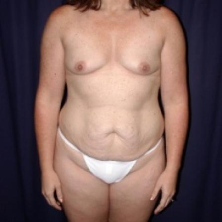 Breast Reduction Before and After Photos by Gary Culbertson, MD