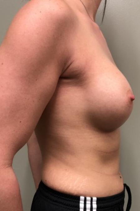 After image 3 Case #86846 - Submuscular Breast Augmentation with Soft Touch Round Cohesive Silicone Implants