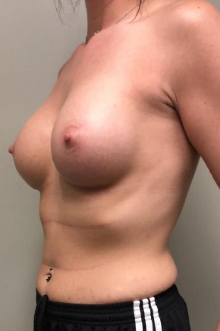 After image 2 Case #86846 - Submuscular Breast Augmentation with Soft Touch Round Cohesive Silicone Implants