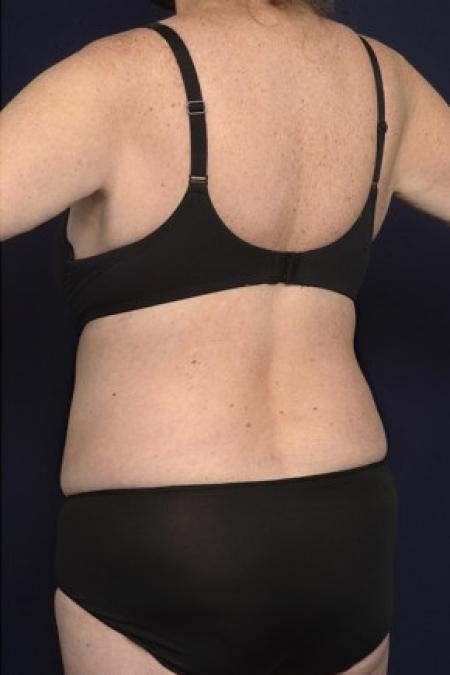 Bra Line Back Lift Before and After Pictures Case 1024