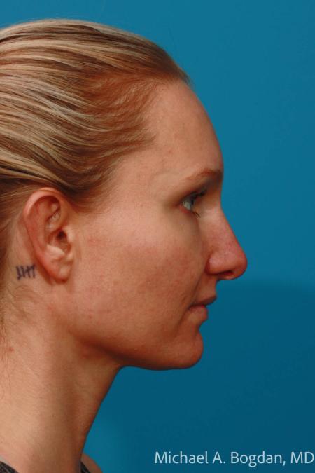 After image 3 Case #108431 - Otoplasty