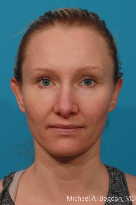 After image 1 Case #108431 - Otoplasty