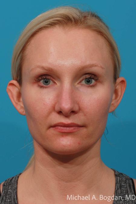 Before image 1 Case #108431 - Otoplasty