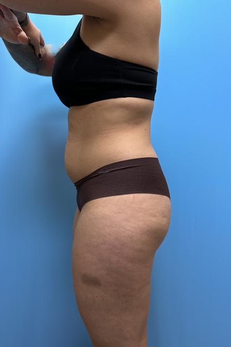 Before image 3 Case #111606 - Liposuction body and thighs with Renuvion