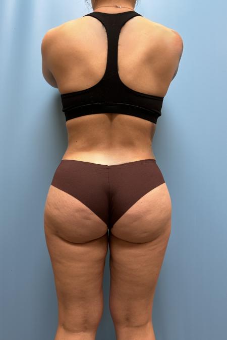 After image 4 Case #111606 - Liposuction body and thighs with Renuvion