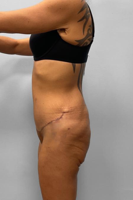 After image 3 Case #111396 - Abdominoplasty & Liposuction