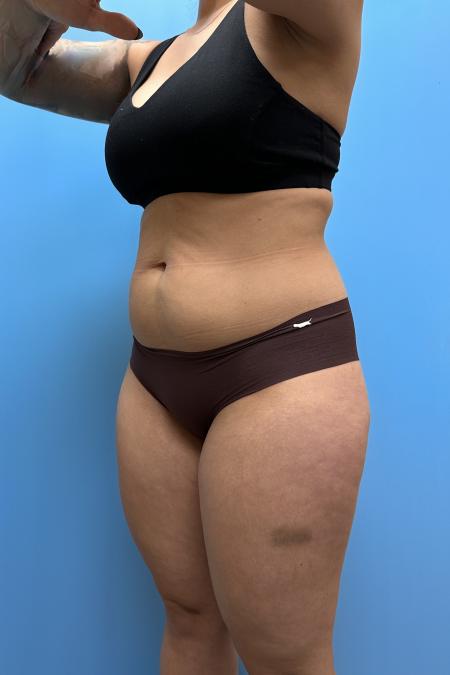 Before image 2 Case #111606 - Liposuction body and thighs with Renuvion