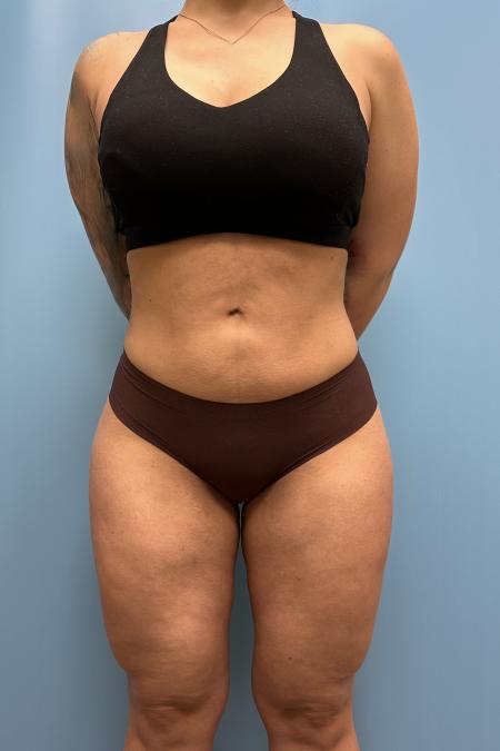 After image 1 Case #111606 - Liposuction body and thighs with Renuvion
