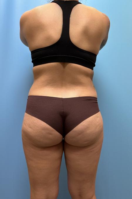 Before image 4 Case #111606 - Liposuction body and thighs with Renuvion