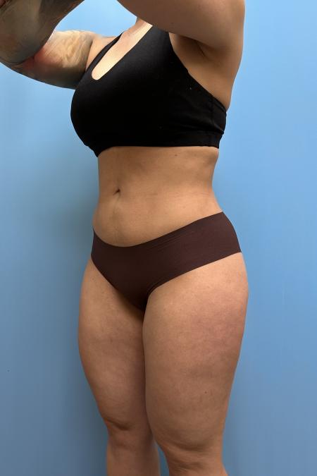 After image 2 Case #111606 - Liposuction body and thighs with Renuvion