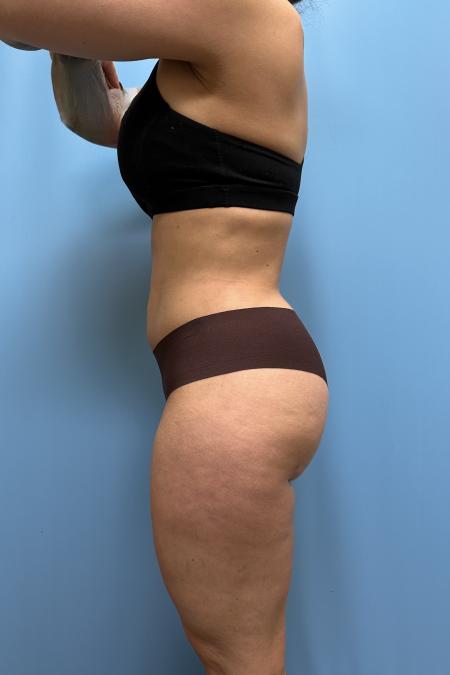 After image 3 Case #111606 - Liposuction body and thighs with Renuvion