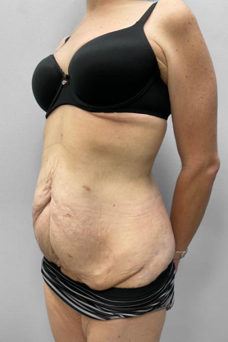 Before image 2 Case #111396 - Abdominoplasty & Liposuction