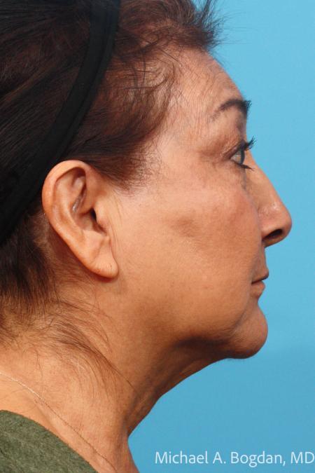 Before image 3 Case #115521 - Face Lift and Blepharoplasty