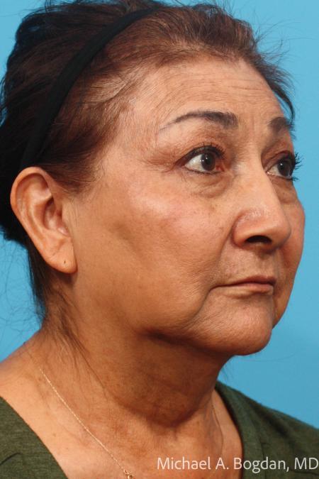 Before image 2 Case #115521 - Face Lift and Blepharoplasty