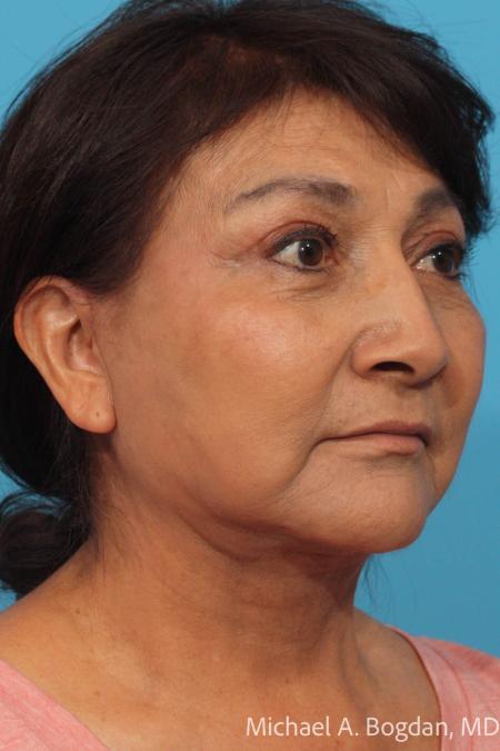 After image 2 Case #115521 - Face Lift and Blepharoplasty