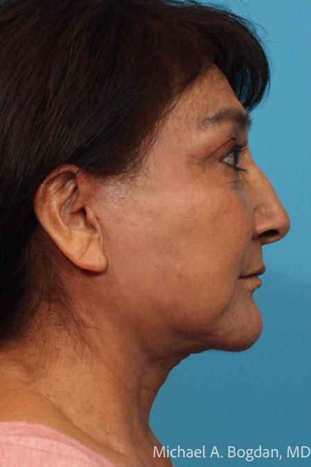 After image 3 Case #115521 - Face Lift and Blepharoplasty