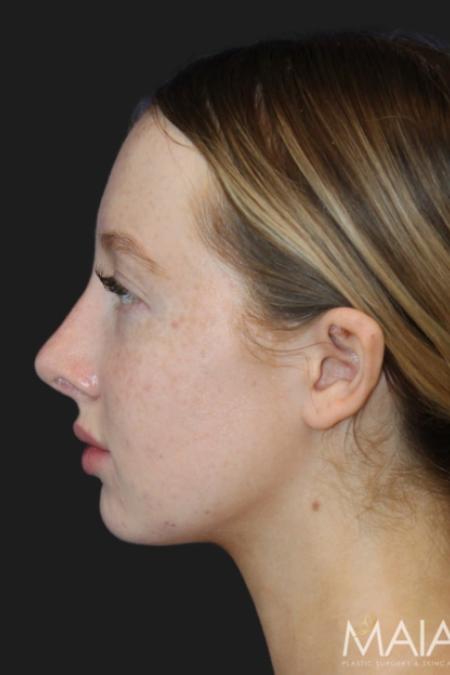 After image 4 Case #116831 - 17 year-old patient | Rhinoplasty 