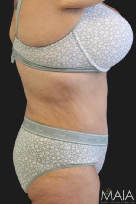 After image 3 Case #116276 - 53 year old patient | Tummy Tuck