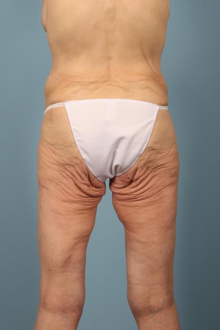 After image 4 Case #116466 - Weight Loss Contouring